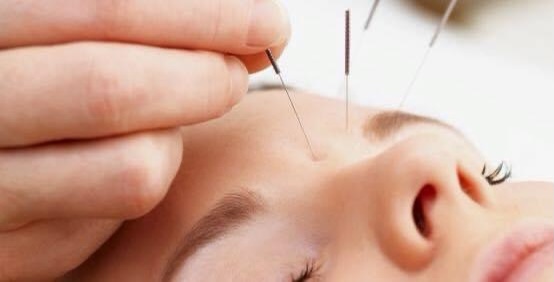soins visages : lifting par acupuncture